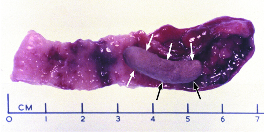 Appendizitis. Aufgeschnittener Wurmfortsatz mit einem Kotstein (Pfeile) als Ursache der Appendizitis.