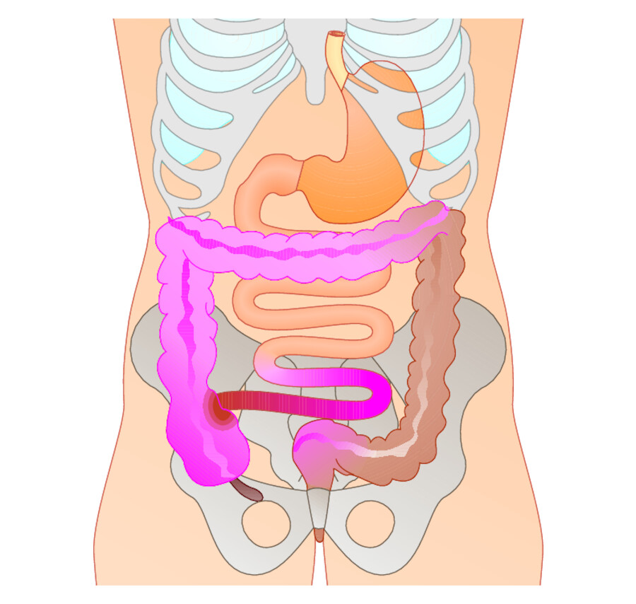 Organbefall bei Morbus Crohn. Am häufigsten sind der untere Dünndarm, das rechte Hemikolon und das Sigma befallen.