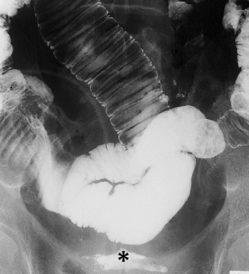 Auf diesem Röntgenbild ist zu erkennen, dass sich die Harnblase (*) ebenfalls mit dem Kontrastmittel aus dem Darm füllt, was auf eine Fistel zwischen Darm und Harnblase hinweist.