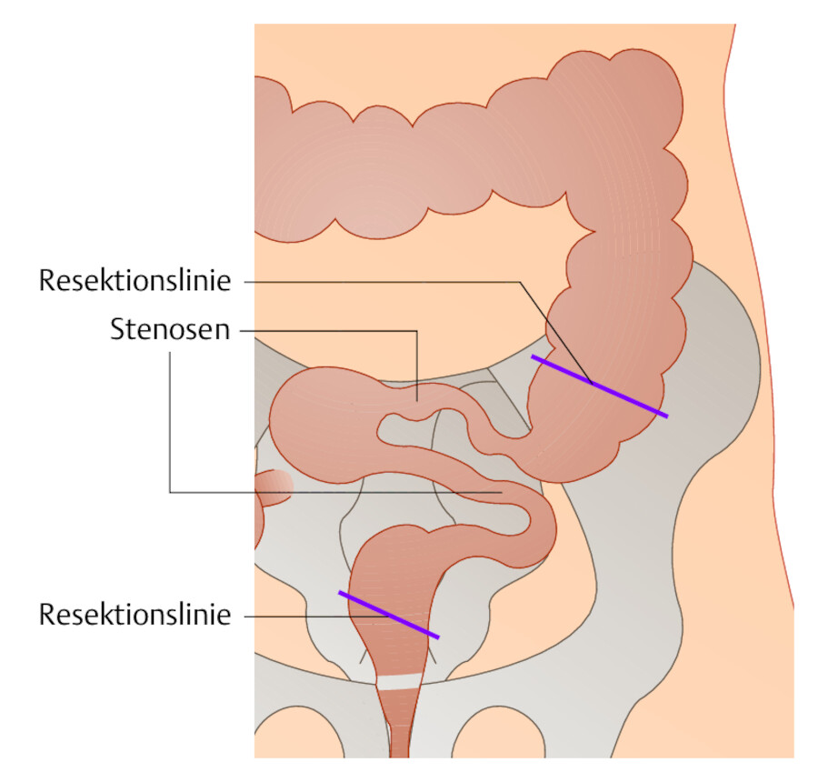 Ausgangsbefund mit Stenose und Divertikeln im Colon sigmoideum.