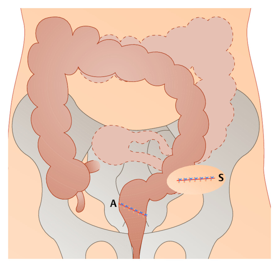 Die End-zu-End-Anastomose (A) wurde laparoskopisch vorgenommen. Über den kleinen Hautschnitt (S) im linken Unterbauch wurde das Dickdarmresektat entfernt.