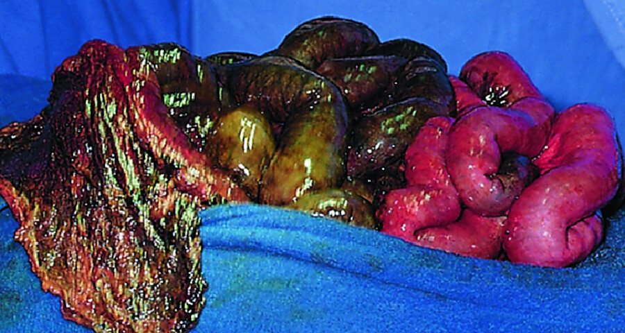 Mesenterialinfarkt. Intraoperativer Befund bei Verschluss der oberen Darmarterie durch Embolie. Links im Bild das große Netz und irreversibel geschädigte Dünndarmschlingen (dunkel). Rechts im Bild noc