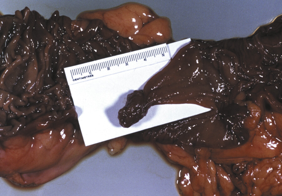 Kolonadenom. Gutartiger gestielter Tumor (Polyp).