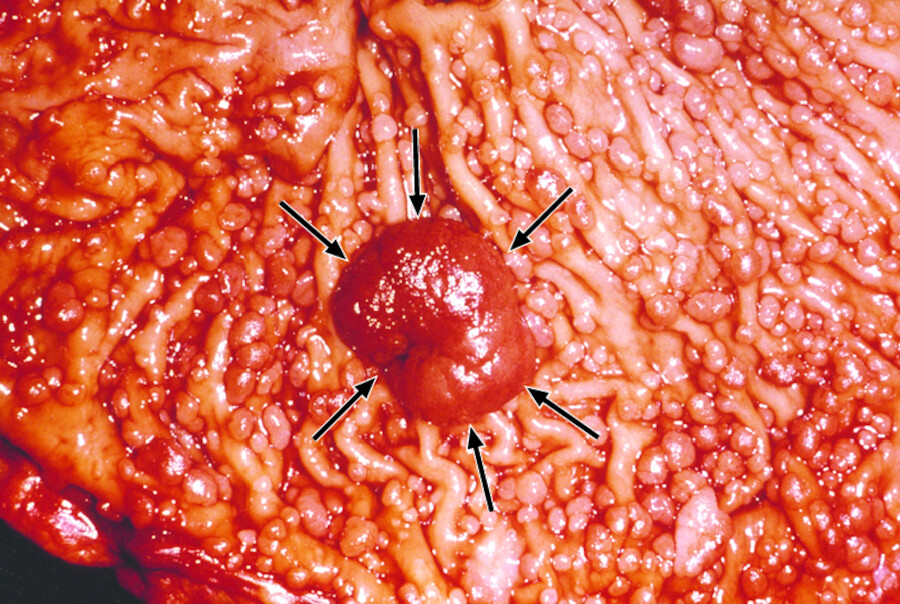 Familiäre adenomatöse Polyposis. Im operativ entfernten und aufgeschnittenen Dickdarm sieht man unzählige kleine Polypen, von denen einer zu einem großen Karzinom (Pfeile) entartet ist.