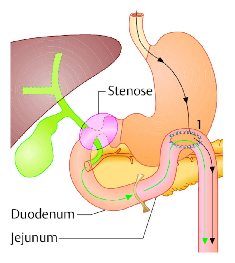 Die palliative Umgehung einer Stenose des Magenausgangs durch Gastroenterostomie = GE (1) hat den Nachteil, dass Galle- und Pankreassaft in den Magen fließen (Passage mit grünen Pfeilen).