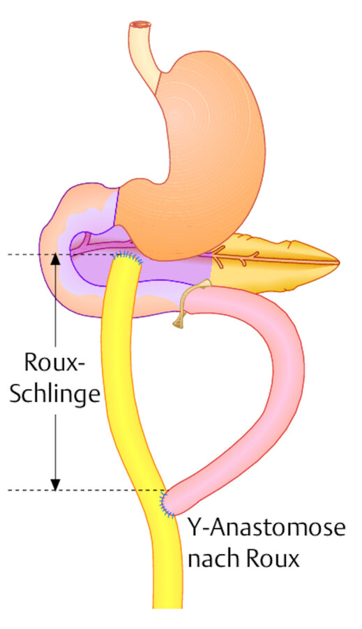 Der distale Dünndarmschenkel kann dann hochgezogen und mit einem anderen Hohlorgan anastomosiert werden (Beispiel: Pankreaskopfzyste).