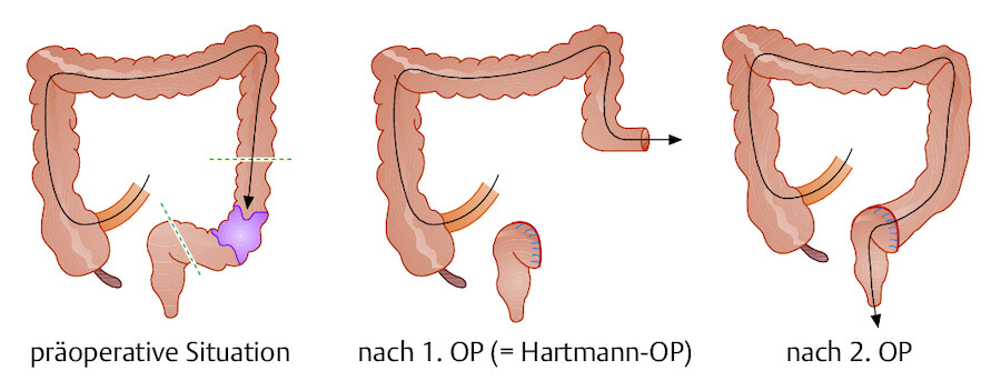 Zweizeitige Sigmaresektion. Beim Notfalleingriff (Peritonitis oder Ileus) erfolgt beim Ersteingriff lediglich die Resektion des erkrankten Darmabschnitts (= Krankheitsherd) mit Anlage eines Anus praet