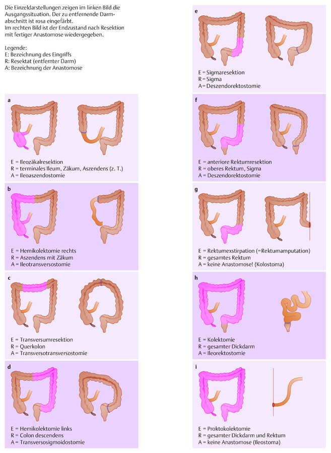 Operative Verfahren an Kolon und Rektum.