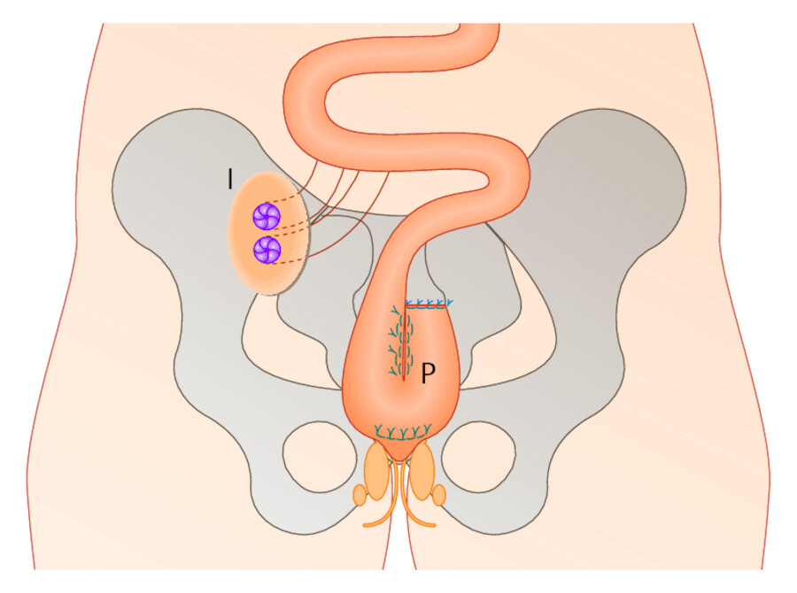 Kontinenzerhaltende Proktokolektomie mit Ileum-Pouch. Das doppelläufige Ileostoma (I) wird nach einigen Wochen zurückverlagert. Das Pouch-Reservoir (P) bleibt.