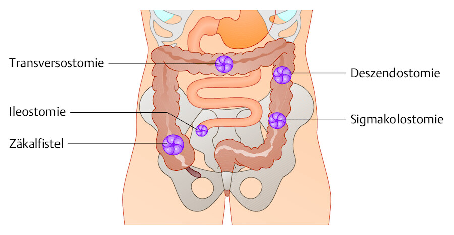 Enterostoma. Verschiedene Lokalisationen des Anus praeter.