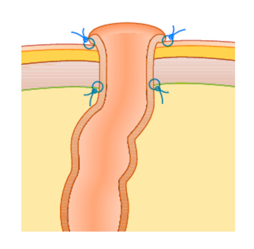 Endständiges Stoma.