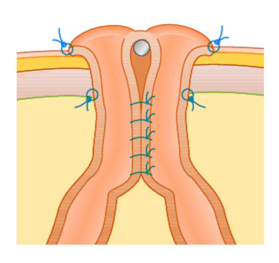 Doppelläufiges Stoma (mit noch liegendem Reiter).