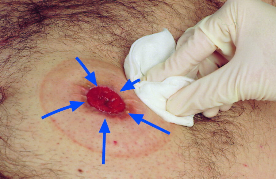 Reinigung des Stomas mit feuchter Kompresse von außen nach innen.