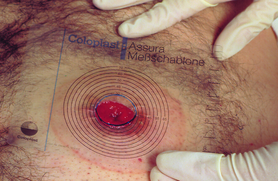 Zur Kontrolle wird die Schablone nochmals angehalten. Die Aussparung darf nicht größer als das Stoma sein! (Gefahr der Hautreizung durch Kontakt mit Ausscheidungen)