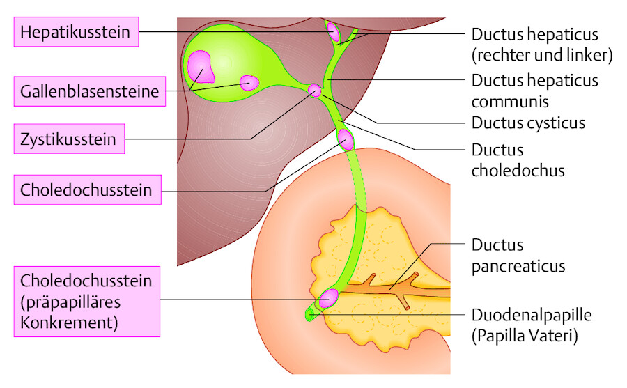 Gallensteine. Typische Lokalisationen von Gallensteinen und ihre Bezeichnungen.