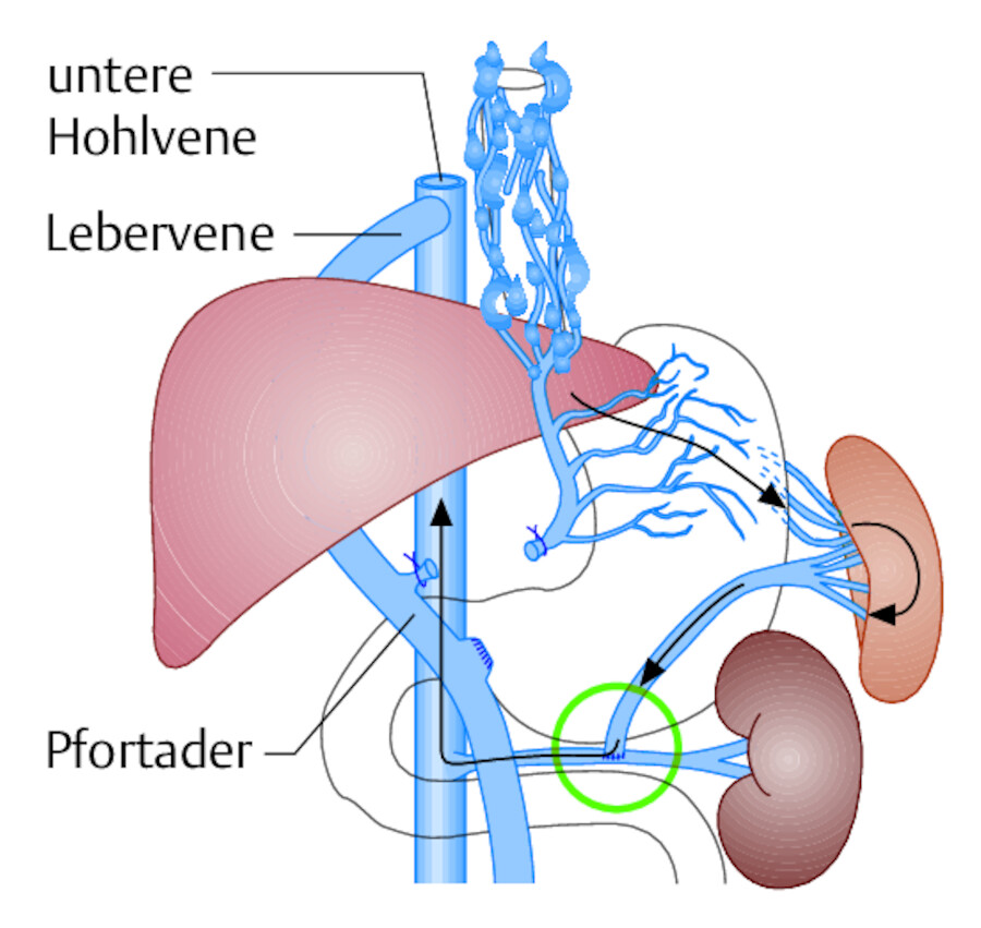 Splenorenaler Shunt nach Warren: Das Blut aus dem Pfortadersystem wird über eine operativ geschaffene Anastomose zwischen Milzvene und linker Nierenvene in die untere Hohlvene abgeleitet.