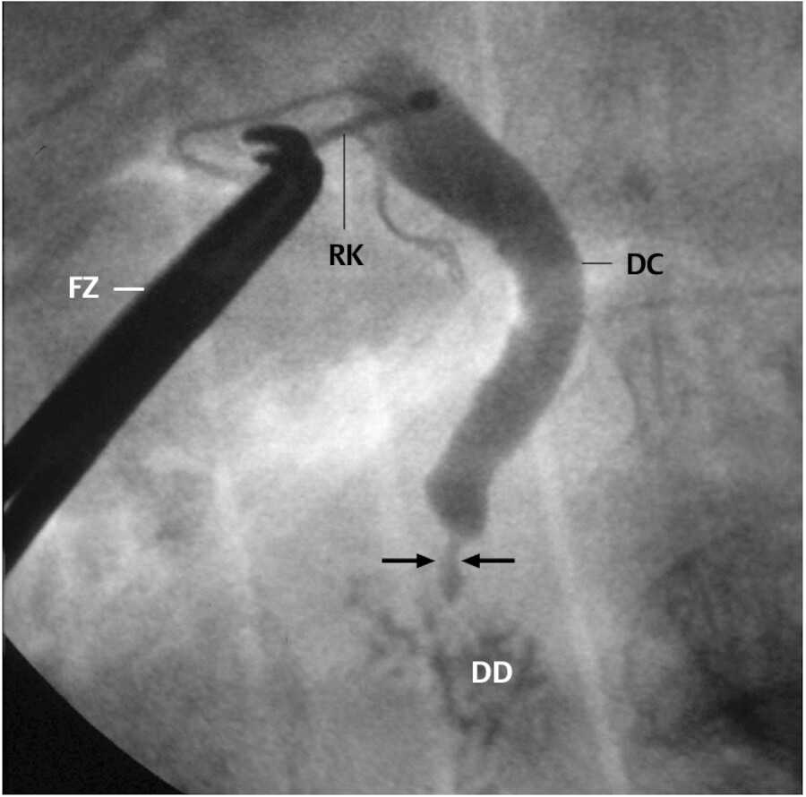 Intraoperative Choledochografie. Eine Fasszange (FZ) hält die Röntgenkanüle (RK). Der Ductus choledochus (DC) füllt sich mit Kontrastmittel, welches in das Duodenum (DD) abfließt. Die Engstellung (Pfe