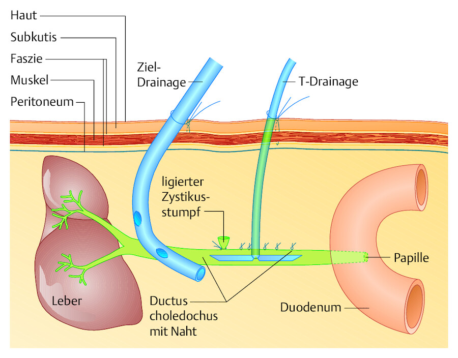 Choledochusrevision. Schematischer Längsschnitt durch den Gallengang (liegender Patient). Postoperativer Zustand nach offener Cholezystektomie und Gallengangsöffnung mit Drainagen.