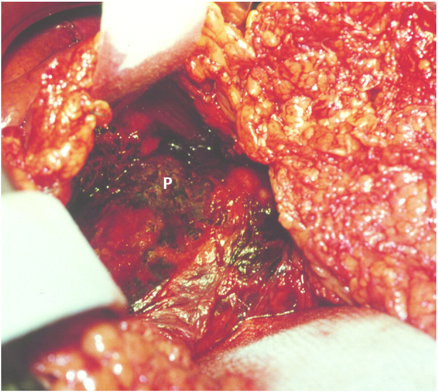 Nekrotisierende Pankreatitis. Operationsfoto: abgestorbenes Pankreasgewebe (P) in der Tiefe, rechts im Bild das große Netz (Omentum majus).