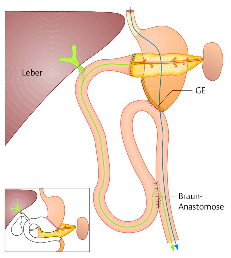 Partielle Duodenopankreatektomie. Ergebnis nach der Wipple-OP. Die Kontinuitätswiederherstellung erfolgt durch Anastomosierung von Pankreasrest, Ductus hepaticus und Magen an eine Jejunumschlinge. Im 