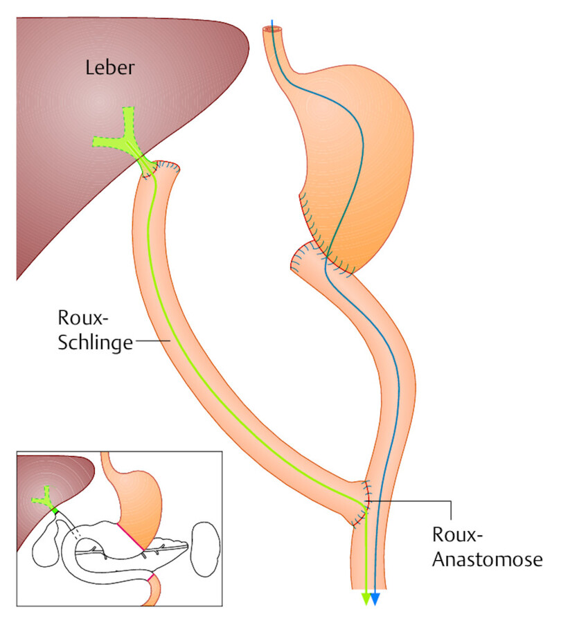 Totale Duodenopankreatektomie. Von den verschiedenen Rekonstruktionsmöglichkeiten wurde hier die Anastomosierung mithilfe einer Roux-Schlinge gewählt. Im kleinen Bild sind die Organe, die entfernten w