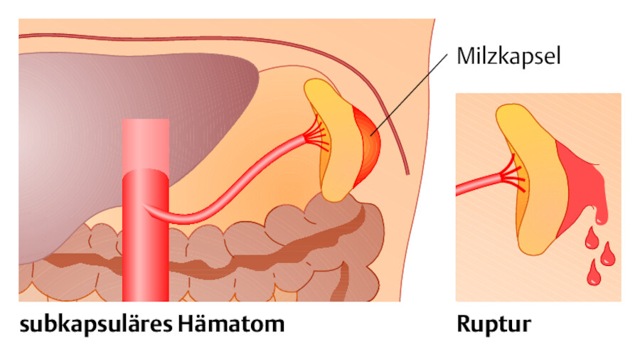 Zweizeitige Milzruptur. Bei Verletzung der Milz mit Einblutung innerhalb der Organkapsel besteht die Gefahr einer späteren spontanen Zerreißung.