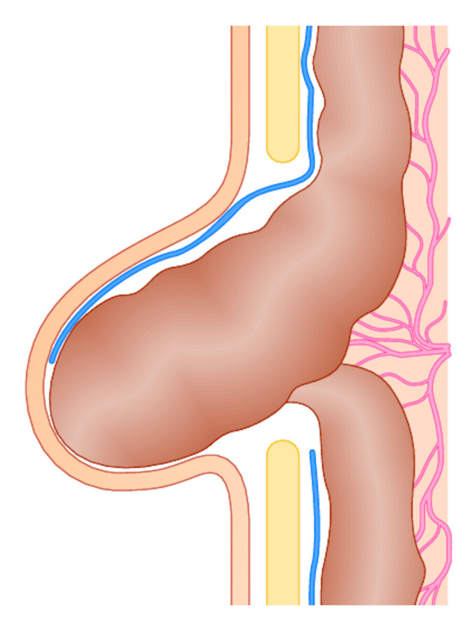 Gleitbruch. Der Bruchsack ist allseits vom Peritoneum ausgekleidet. Teilweise bilden vorgefallene innere Organe die Wand des Bruchsacks.