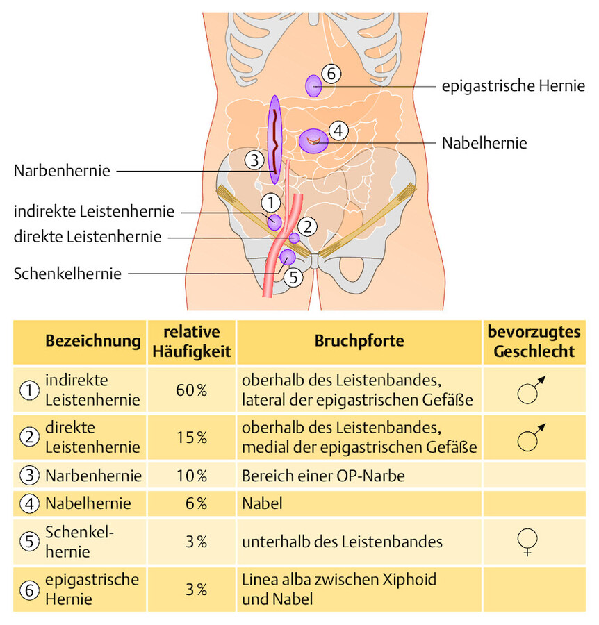 Hernien. Lokalisation der wichtigsten Weichteilbrüche.