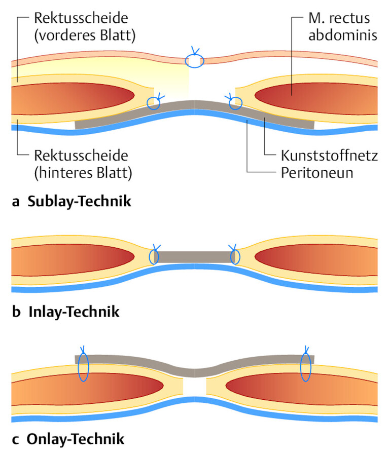 Therapie von Narbenhernien. Die Bruchpforte wird mit einem Kunststoffnetz verschlossen. Dieses kann hinter (a), zwischen (b) oder vor (c) die geraden Bauchmuskeln platziert werden (IPOM).