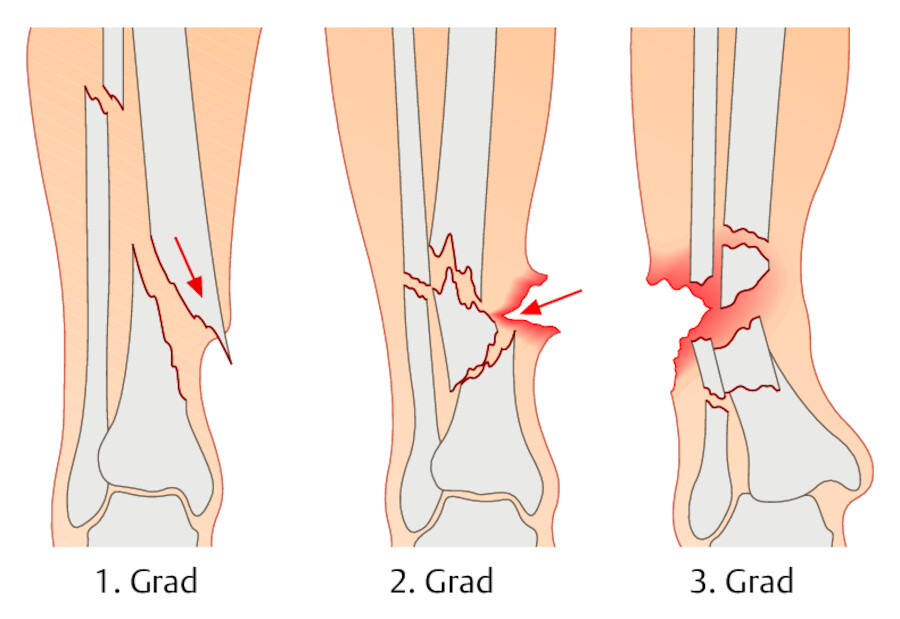 Schweregrade der offenen Fraktur.