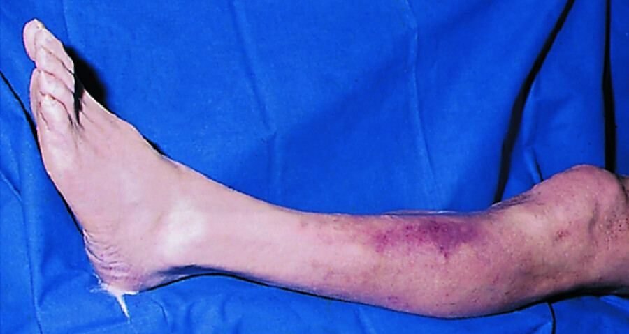 Tibialis-anterior-Syndrom. Ischämische Blaufärbung über dem vorderen Schienbeinmuskel (Kompartmentsyndrom).