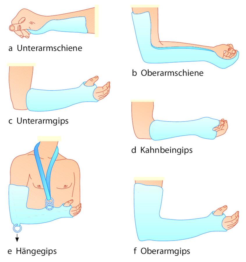 Gipsverbände der oberen Extremität. Beispiele.