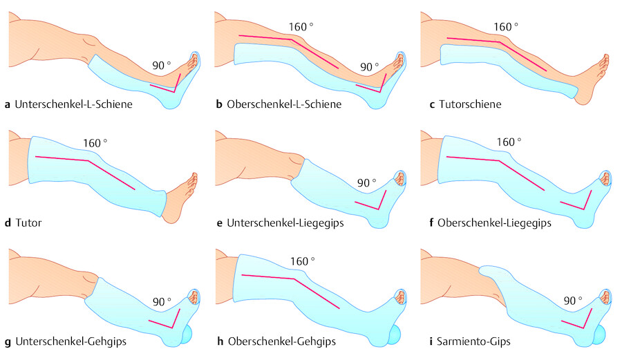 Gipsverbände der unteren Extremität. Beispiele.