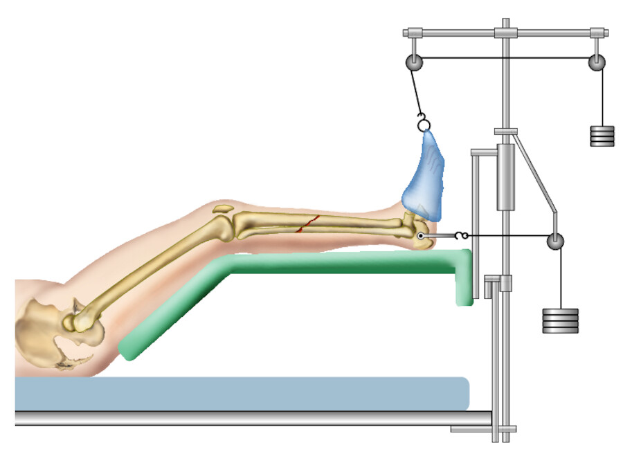 Extensionsbehandlung. Beim Streckverband (hier: Unterschenkelfraktur) wurde der Fuß zur Spitzfußprophylaxe mit einem Schlauchverband versehen und mithilfe des Extensionsgestänges in 90°-Stellung fixie