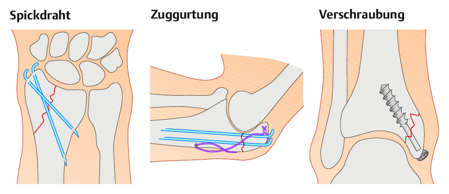 Osteosyntheseverfahren (I). Operative Fixierung bei kleineren Bruchstücken.