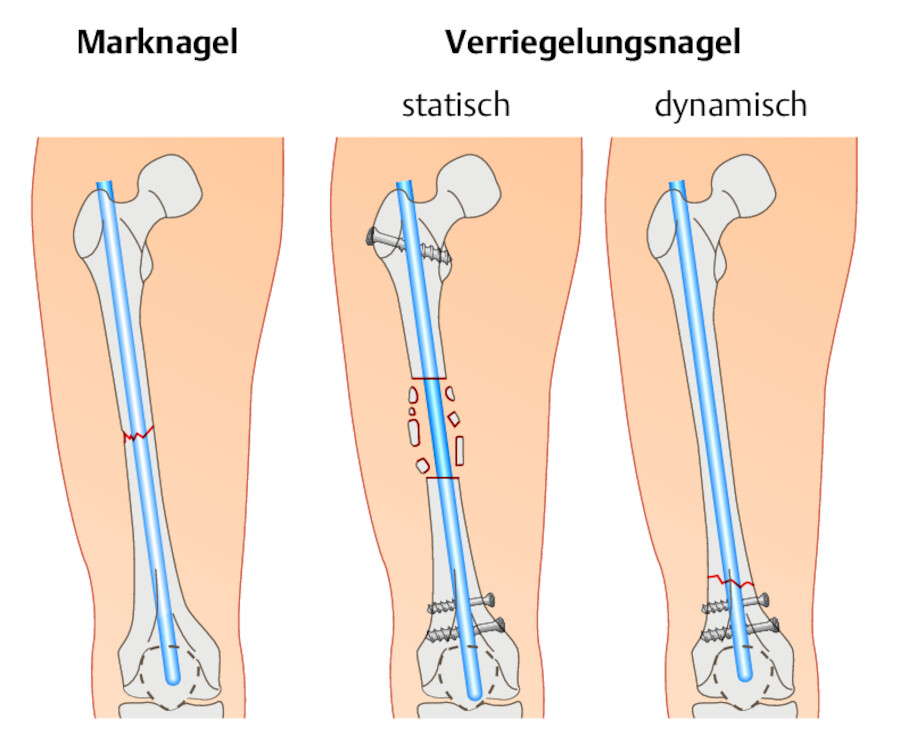 Osteosyntheseverfahren (II). Intramedulläre Schienung.