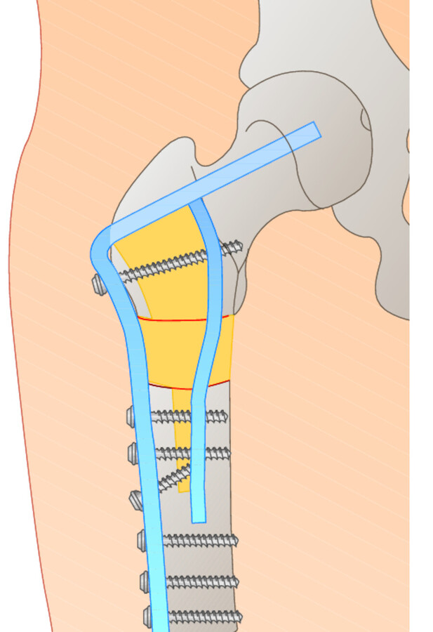 Schematische Darstellung am Beispiel einer Femurfraktur (Knochenzement gelb).