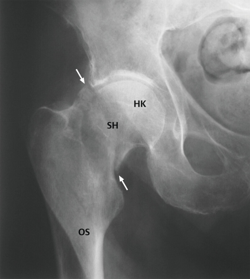 Röntgenaufnahme der Hüfte. Bruchspalt (Pfeile), SH: Schenkelhals, HK: Hüftkopf, OS: Oberschenkelknochen (Femur).