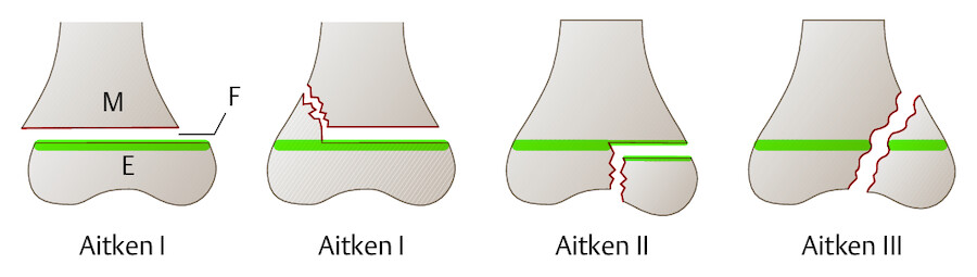 Epiphysenverletzungen im Wachstumsalter. Einteilung nach Aitken (M: Metaphyse, F: Epiphysenfuge, E: Epiphyse):Aitken-I-Fraktur: reine Epiphysenlösung ohne oder mit metaphysärem Keil,Aitken-II-Fraktur: