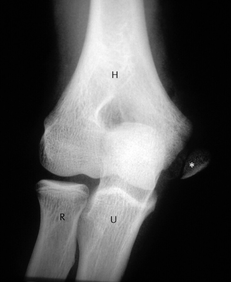 Der knöcherne Muskelansatz (*) am medialen Ellenbogen ist ausgerissen, H: Humerus, U: Ulna, R: Radius.