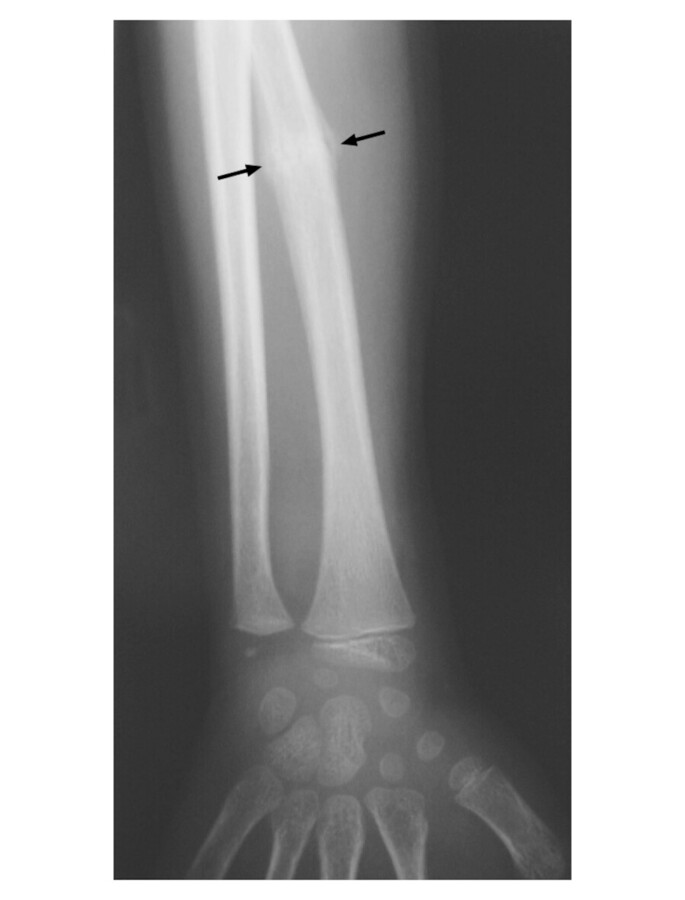 Grünholzfraktur der Speiche. Röntgenbild, 6-jähriges Kind. Keine Dislokation vorhanden, lediglich die gerissene Knochenhaut (Periost) ist sichtbar (Pfeil).