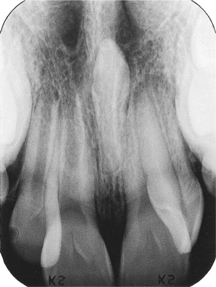 Radiograph displaying mesiodens in an inverted position in midline of maxilla.