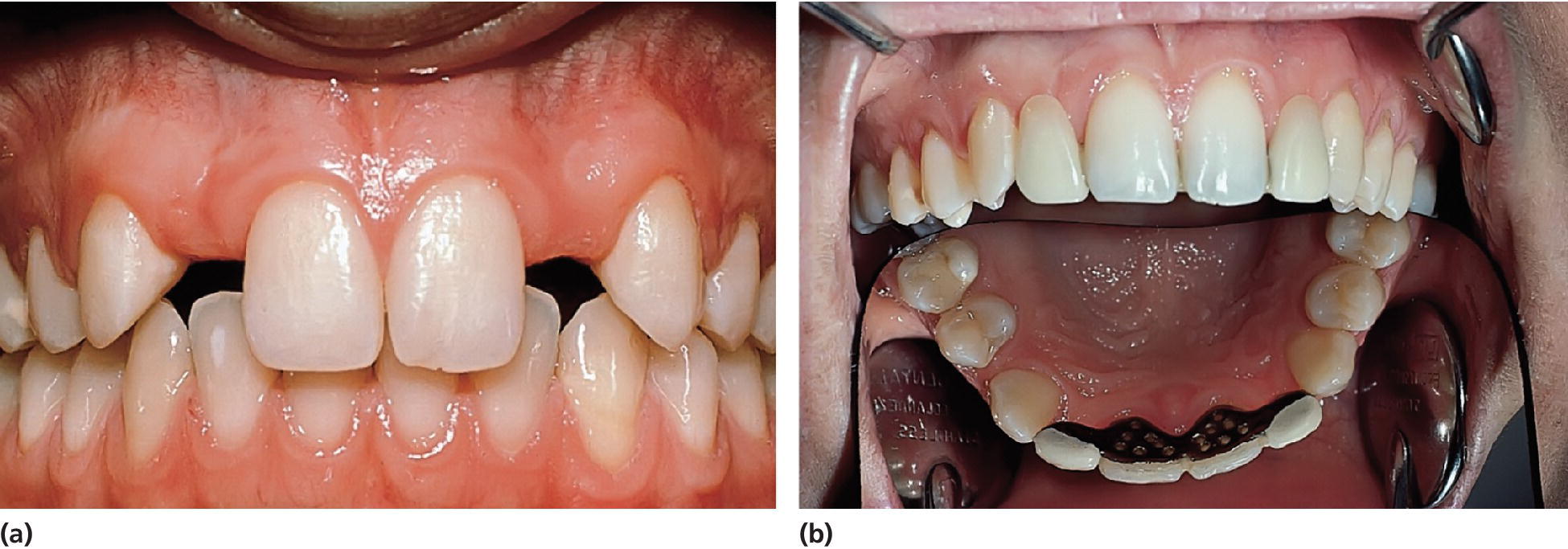 2 Photos of the same boy with hypodontia of permanent maxillary lateral incisors (left) and with laterals replaced with composite-retained onlay bridge (right).