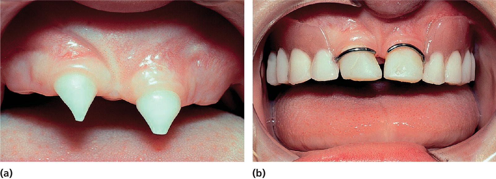 Photos of a boy with ectodermal dysplasia displaying intraoral view with conical primary incisors 51 and 61 (a) and teeth 51 and 61 rebuilt with composite resin and removable partial denture in the maxilla (b).