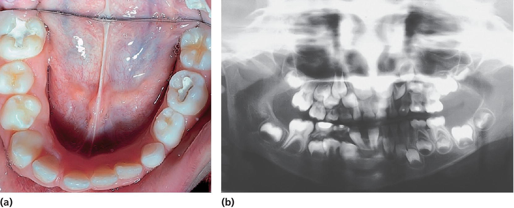 Photos displaying hemifacial hypertrophy on right side (left), and orthopantomogram of developmental differences between permanent first molars in left and right sides (right).