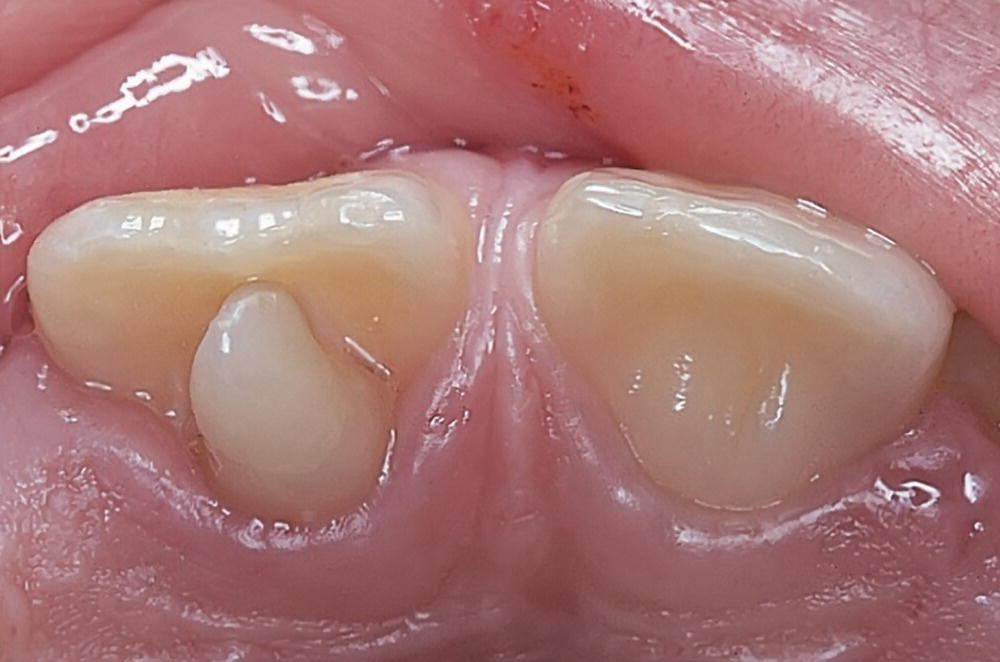 Photo displaying cusp-shaped cingulum of permanent central incisor interfering with occlusion.