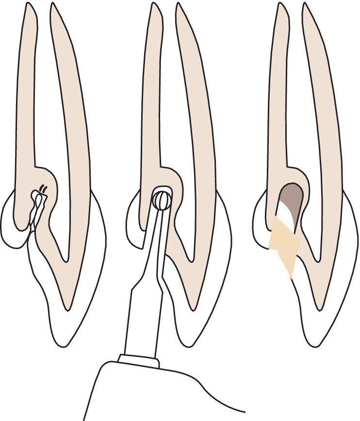 Illustrations of treatment of dens invaginations displaying lumen reamed out with an elongated round drill and bottom and buccal walls of lumen covered calcium hydroxide compound.