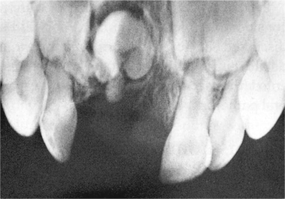 Radiograph of complex odontoma in a 2‐year‐old girl as a result of trauma.