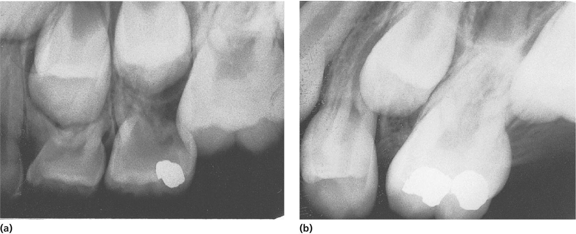 Radiographs depicting retention of permanent maxillary first molar caused by primary second molar (left), and after extraction/exfoliation of primary tooth, loss of space often occur (right).