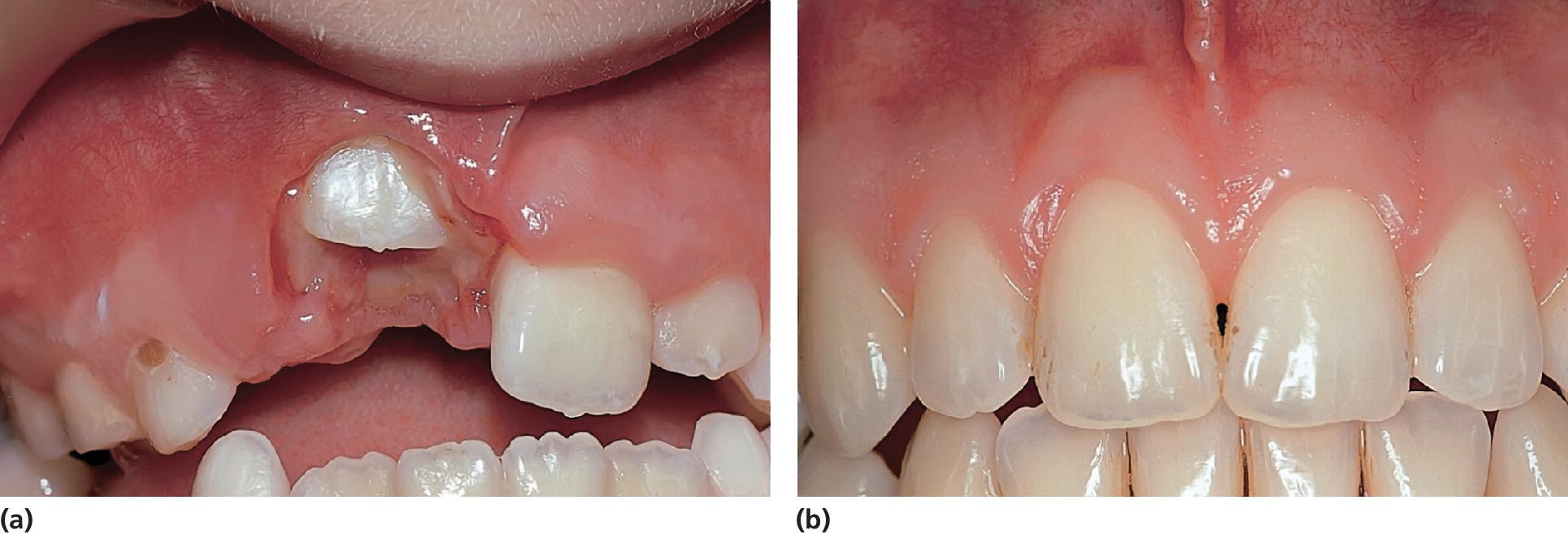 2 Photos of ectopic position of right maxillary central incisor due to supernumerary tooth in the region (left), and restore position of teeth (right).